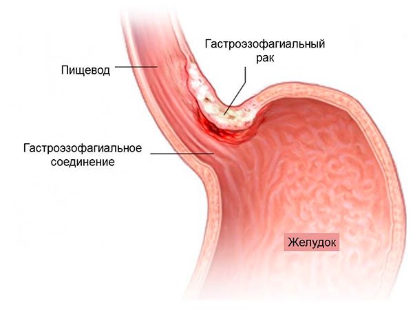 Гастроэзофагеальный рак