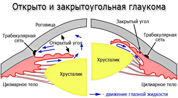 Открыто- и закрытоугольная глаукома