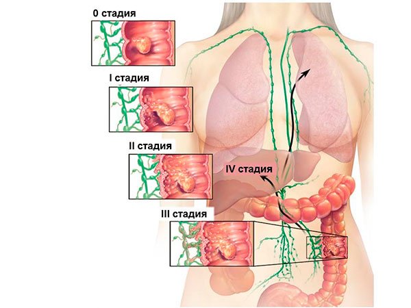 Стадии рака толстой кишки